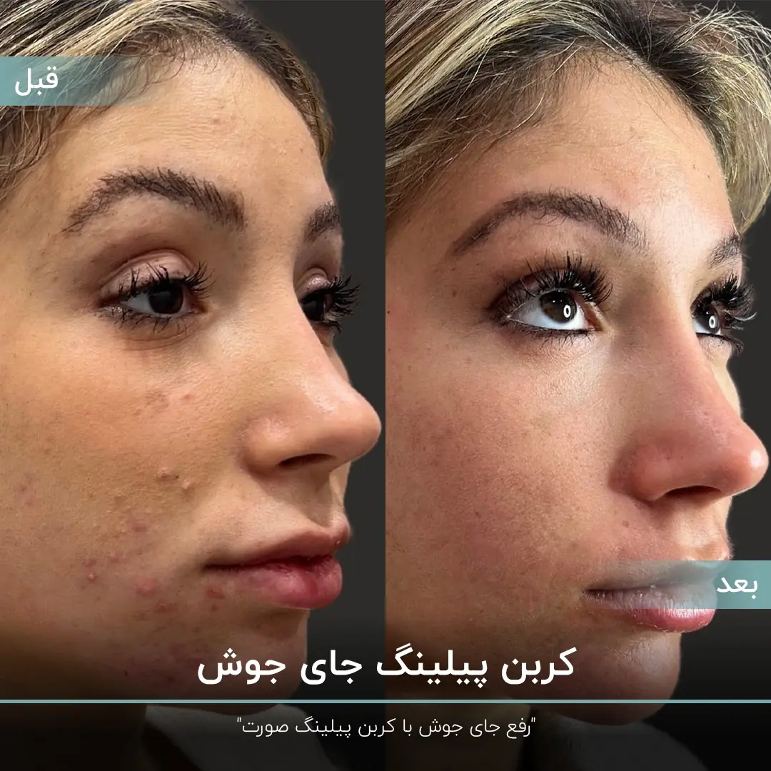 عکس قبل و بعد دختری که جوش های صورت خود را با لیزر کربن پیلینگ درمان کرده است