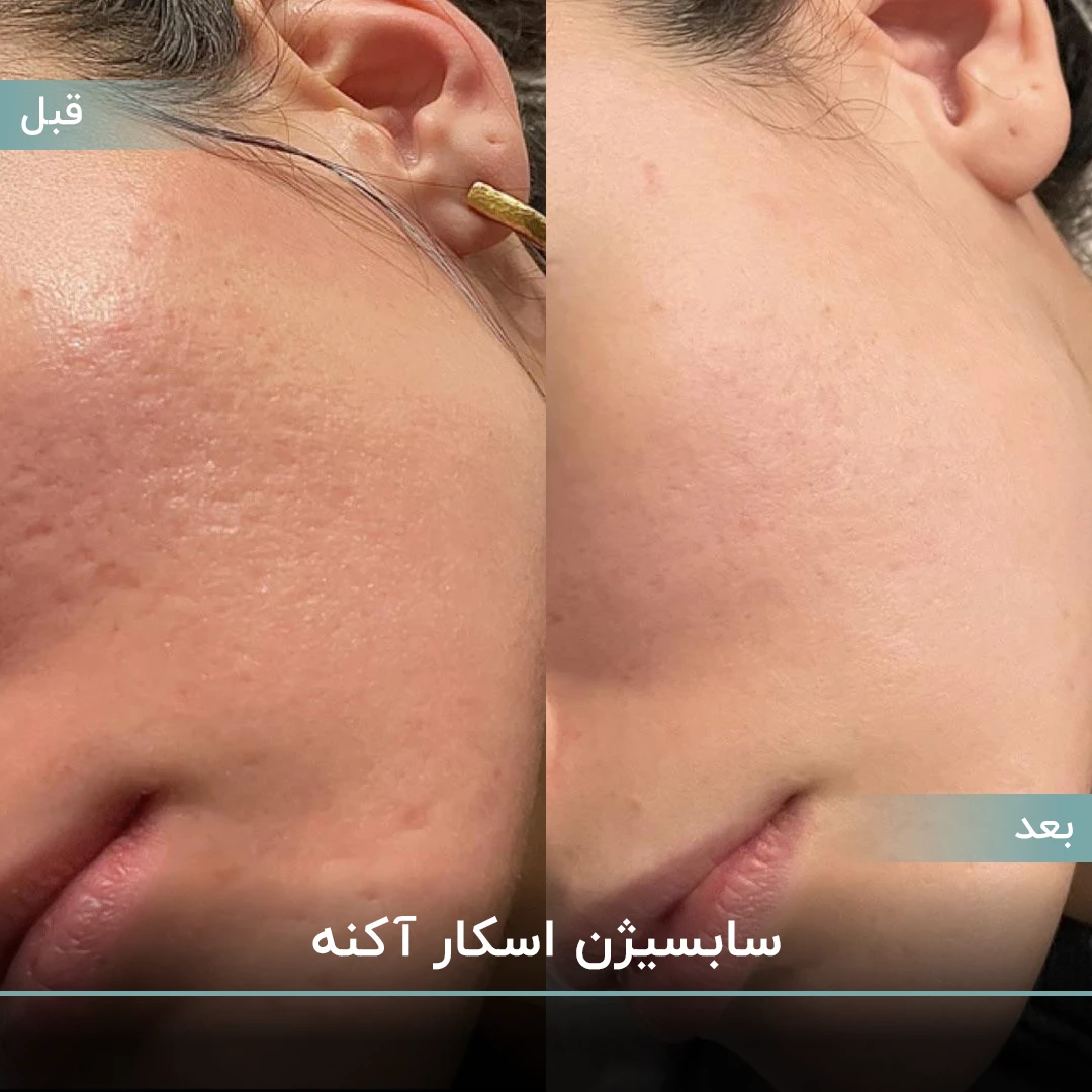 عکس قبل و بعد سابسیژن اسکار آکنه