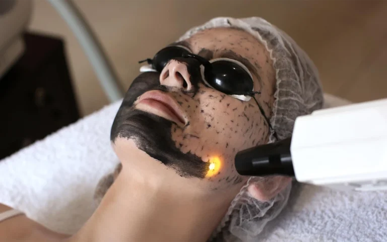 دختری که ماسک کربن روی صورت دارد و پزشک با هندپیس لیزر در حال انجام پیلینگ کربن روی صورت او است