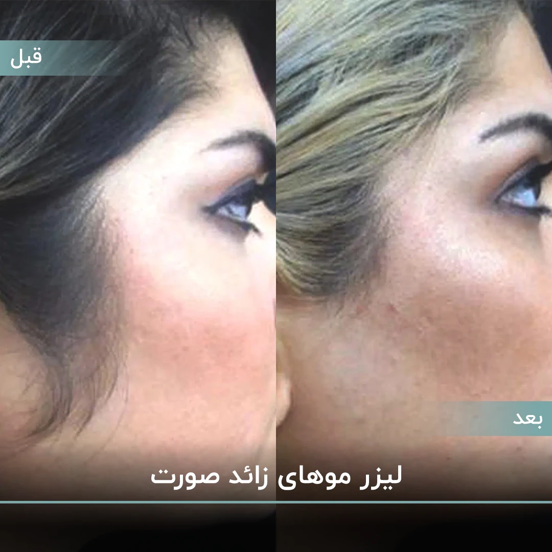عکس قبل و بعد رفع لیزر موهای زائد صورت با لیزر