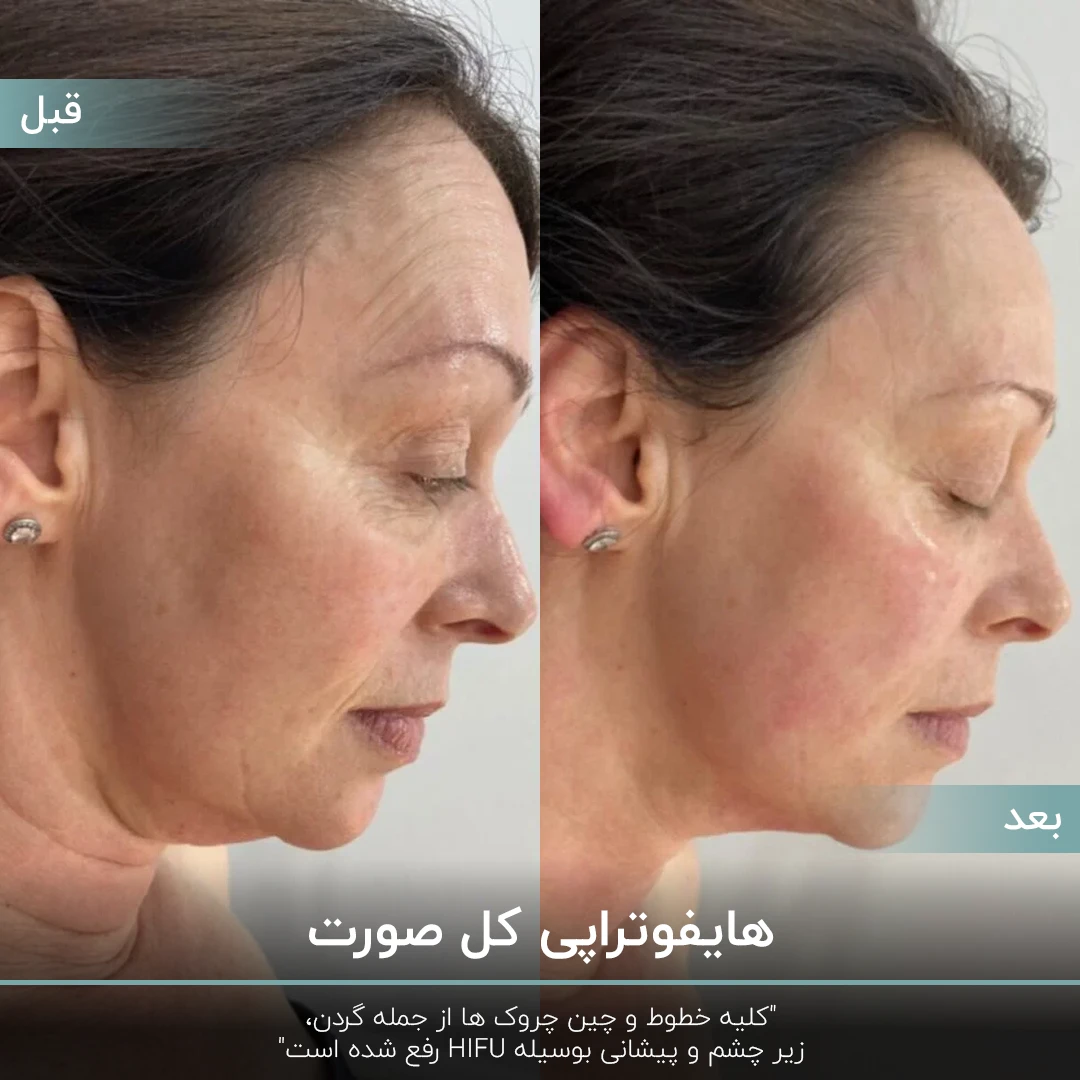 عکس قبل و بعد هایفو کل صورت خانم میانسال