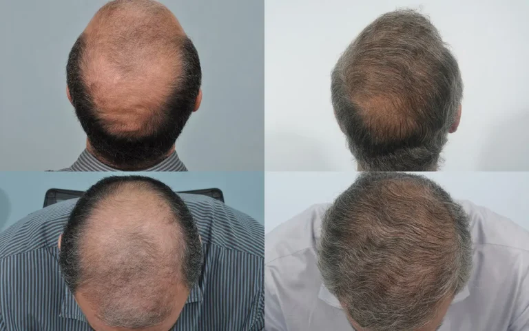 عکس از زوایای مختلف از سر مرد میانسالی که کاشت مو انجام داده است و طاسی سر او به طور کامل رفع شده است