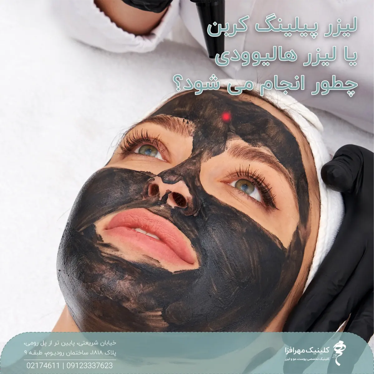 صورت دختری که کربن پیلینگ انجام می دهد