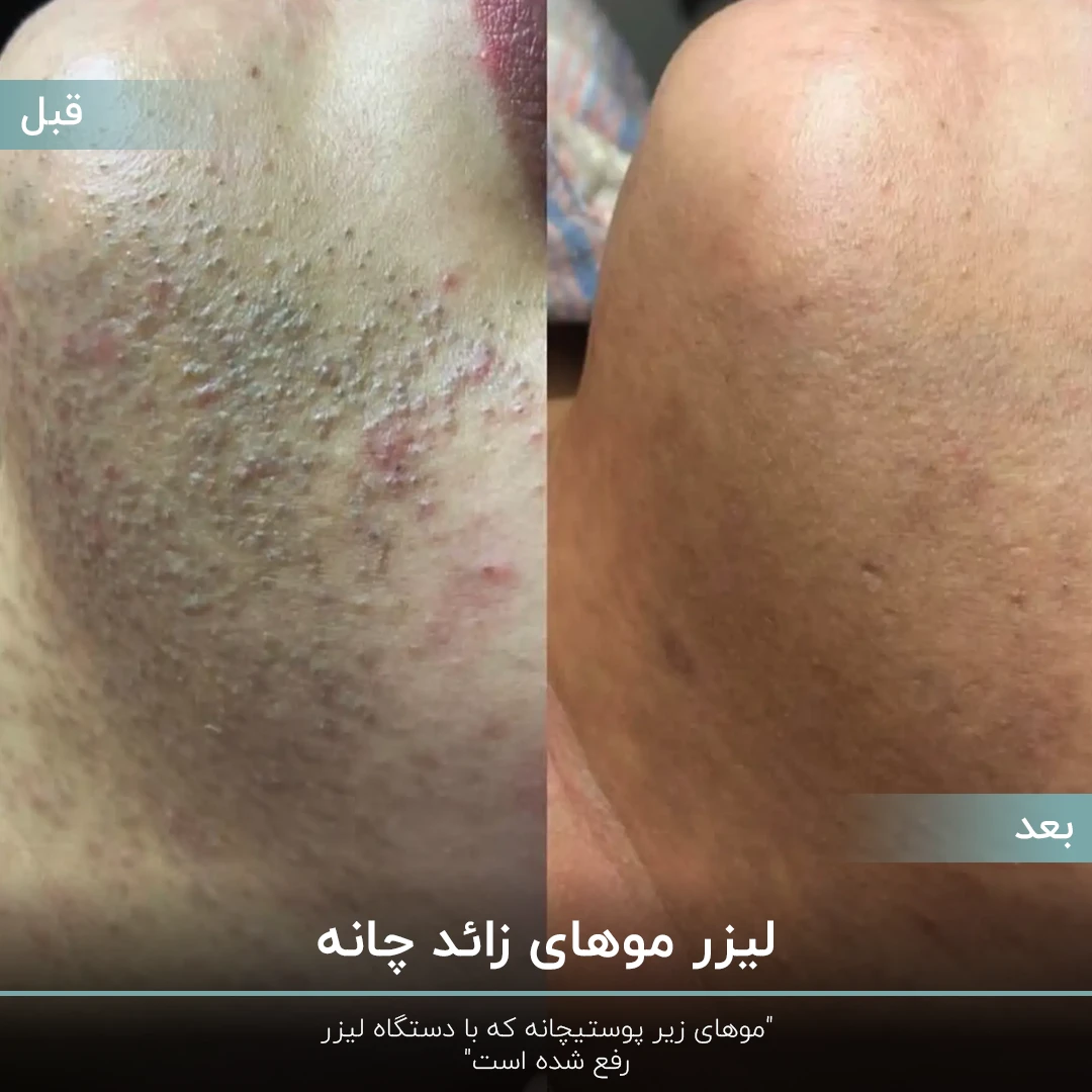 عکس قبل و بعد رفع موهای زیر پوستی چانه فرد با لیزر موهای زائد صورت