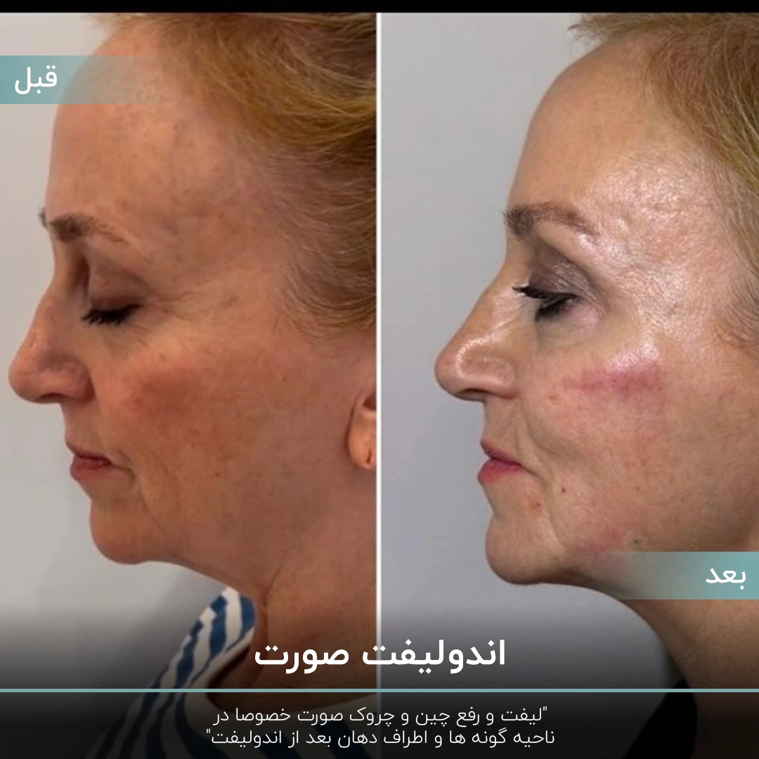 عکس قبل و بعد اندولیفت صورت زن میانسال