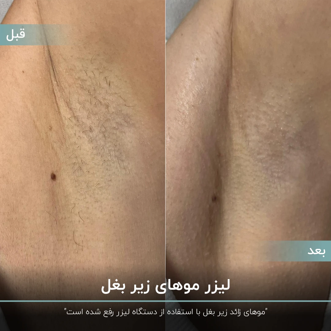عکس قبل و بعد فردی که با لیزر موهای زیر بغل خود را رفع کرده است