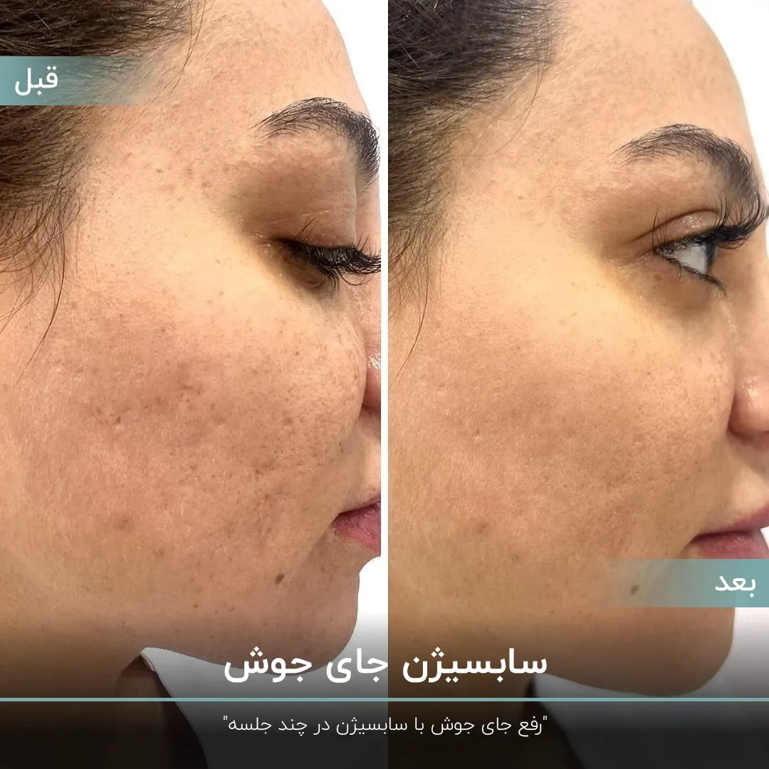 عکس قبل و بعد رفع جای جوش صورت دختر با سابسیژن