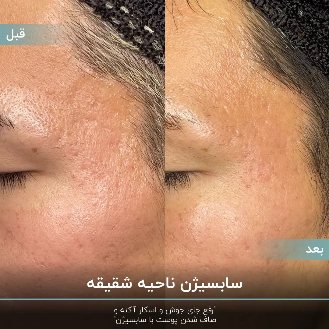 عکس قبل و بعد سابسیژن پوست شقیقه فرد که باعث رفع اسکار آکنه شده است