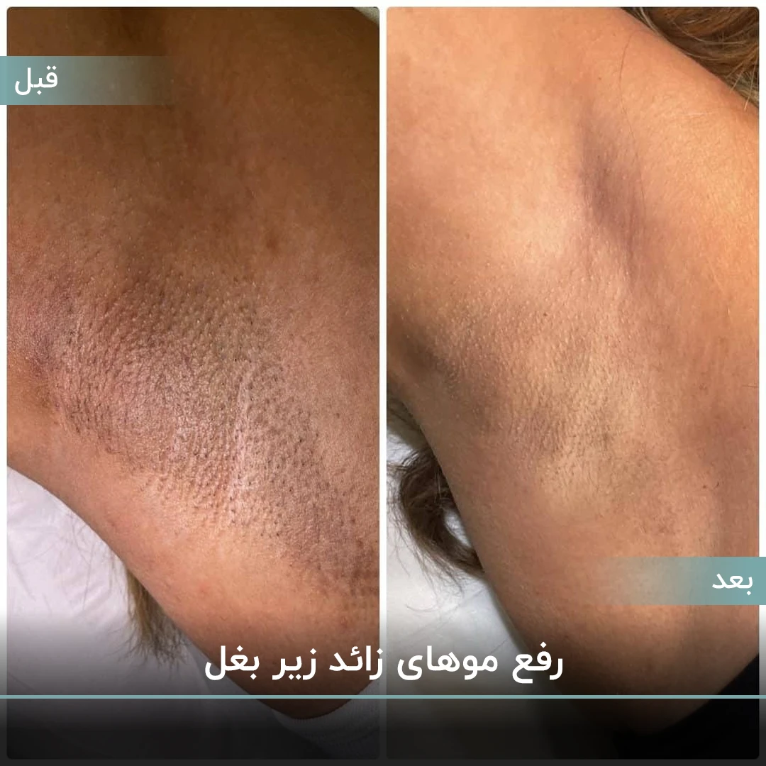 عکس قبل و بعد لیزر موهای زائد زیر بغل