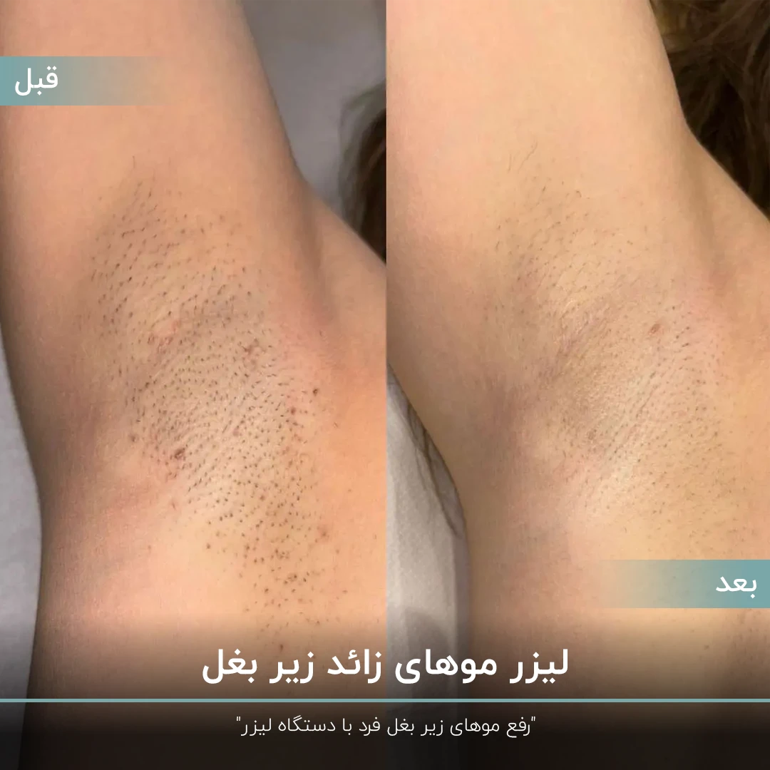 عکس قبل و بعد از لیزر موهای زائد برای زیر بغل فرد