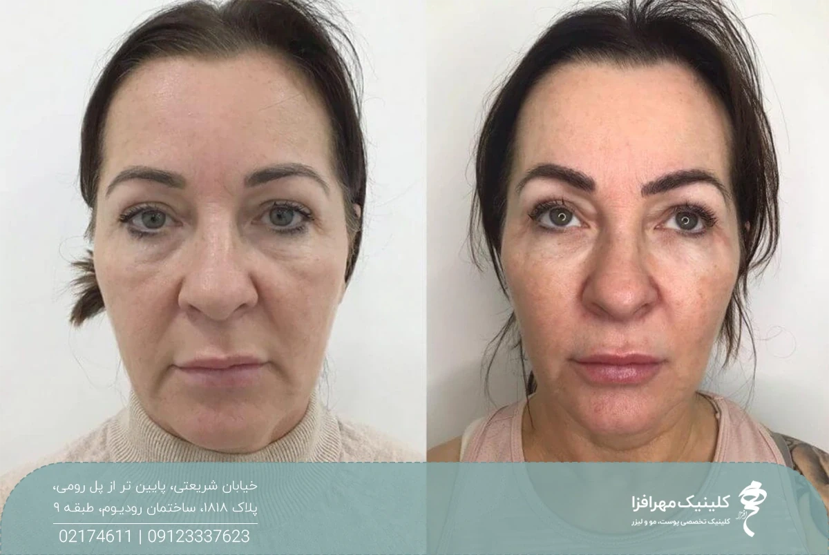 عکس قبل و بعد تزریق پروفایلو به صورت یک زن که باعث لیفت و رفع چین و چروک شده