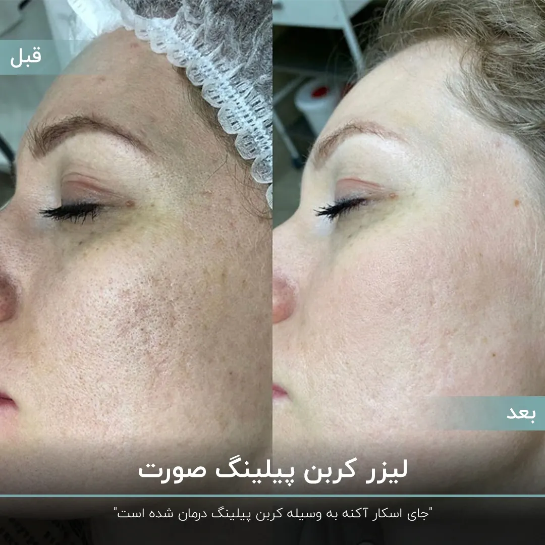 عکس قبل و بعد کربن پیلینگ صورت زن که باعث رفع اسکار آکنه شده است