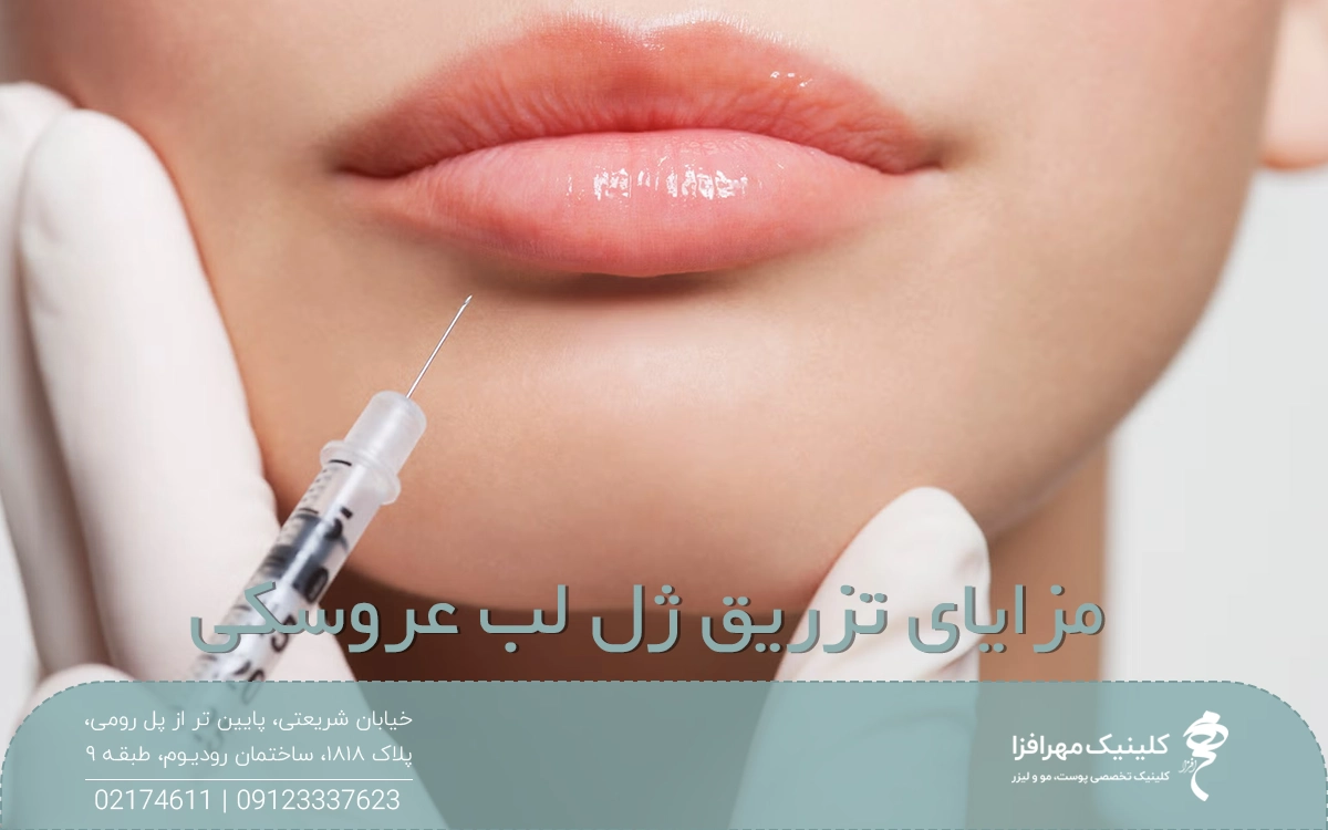 عکس از لب فردی که پزشک سرنگ فیلر را نزدیک لب پایین دختر گرفته است و روی عکس نوشته شده مزایای تزریق ژل لب عروسکی
