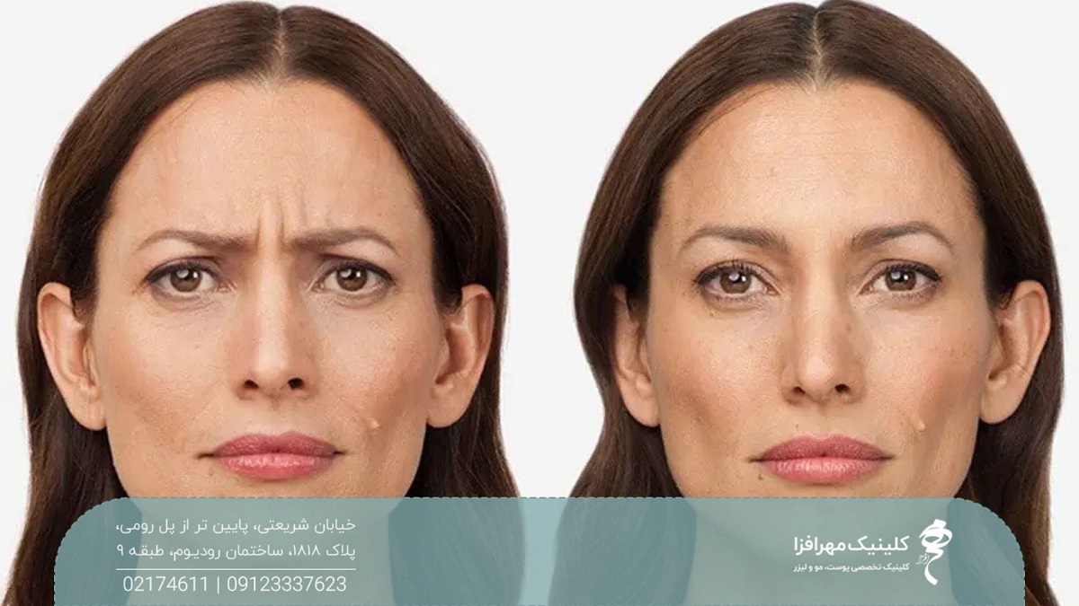 عکس قبل و بعد از صورت زن که تزریق بوتاکس انجام داده است