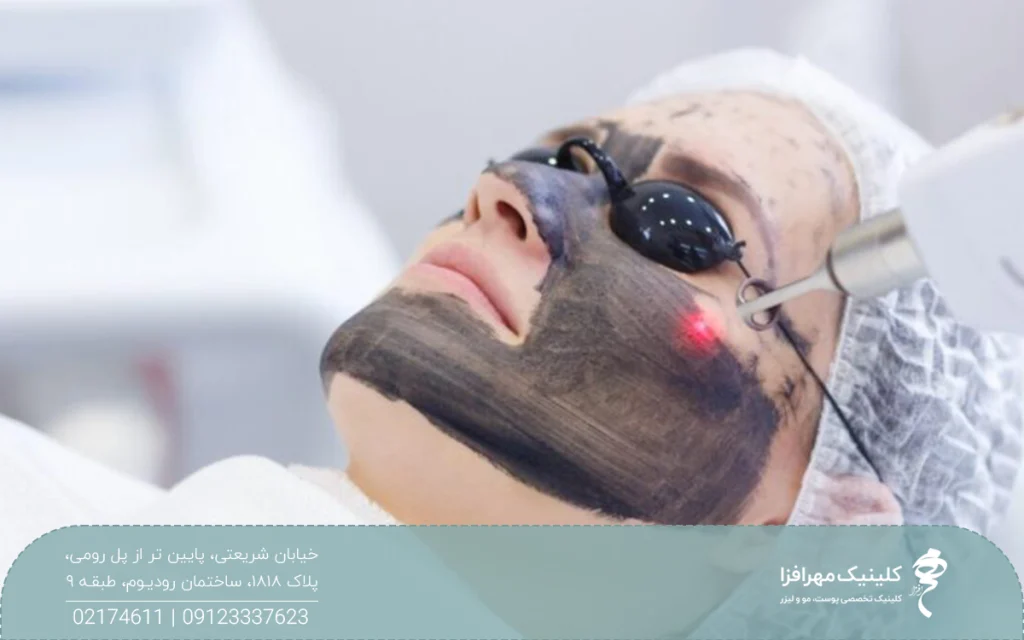 خانمی که خوابیده و کلاه و عینک مخصوص زده است و روی صورتش کربن است و هندپیس دستگاه لیزر روی صورتش است