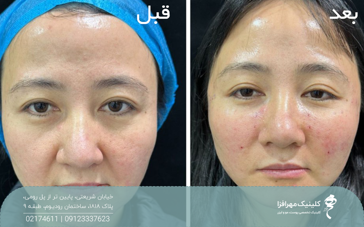 عکس قبل و بعد دختری که لیفت با نخ انجام داده است و صورت او بعد از لیفت نخ ورم کرده است