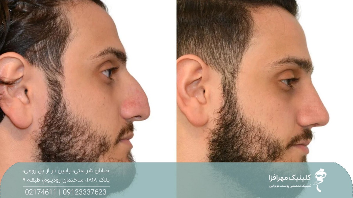 عکس نیم رخ از قبل و بعد عمل بینی مرد جوان