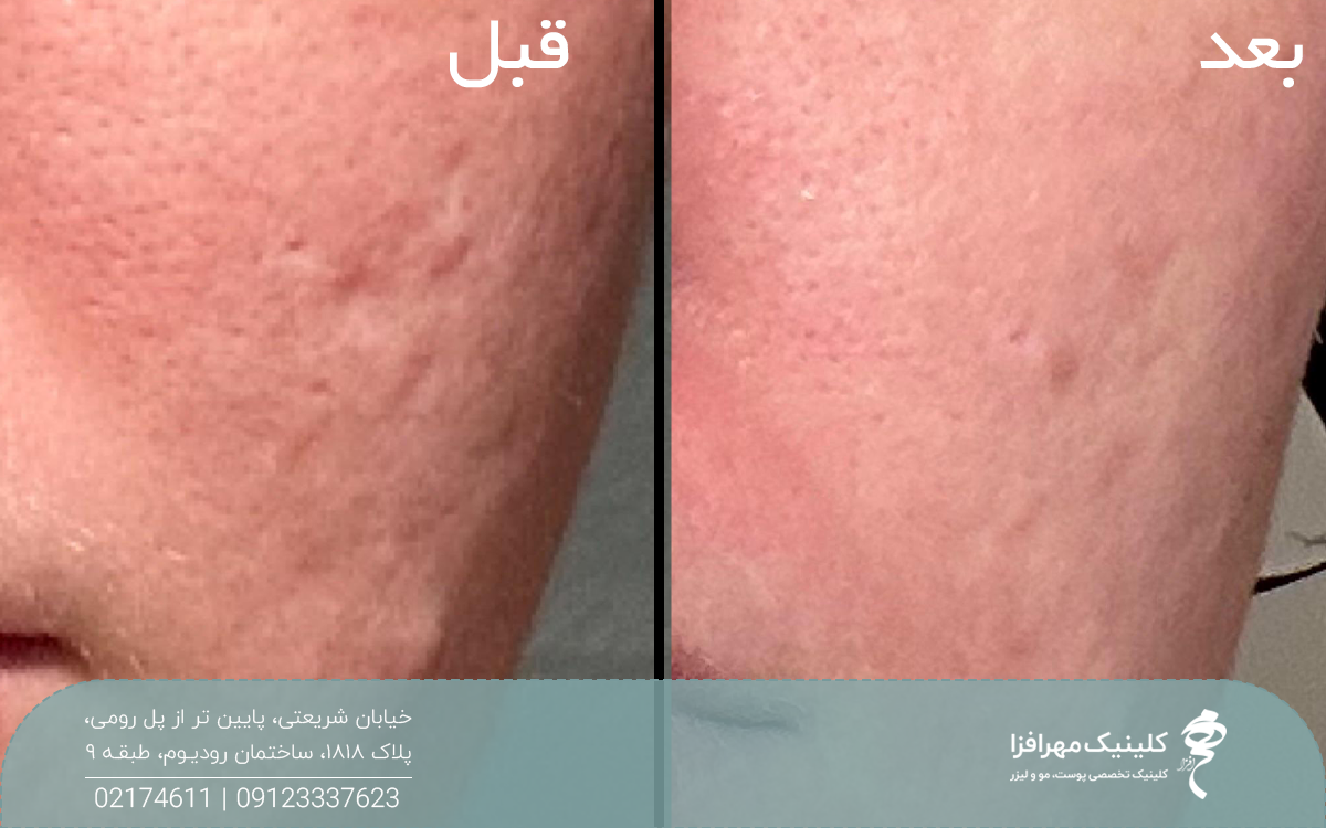 عکس قبل و بعد از فردی که سابسیژن انجام داده است و جای آکنه روی پوست او رفع شده است