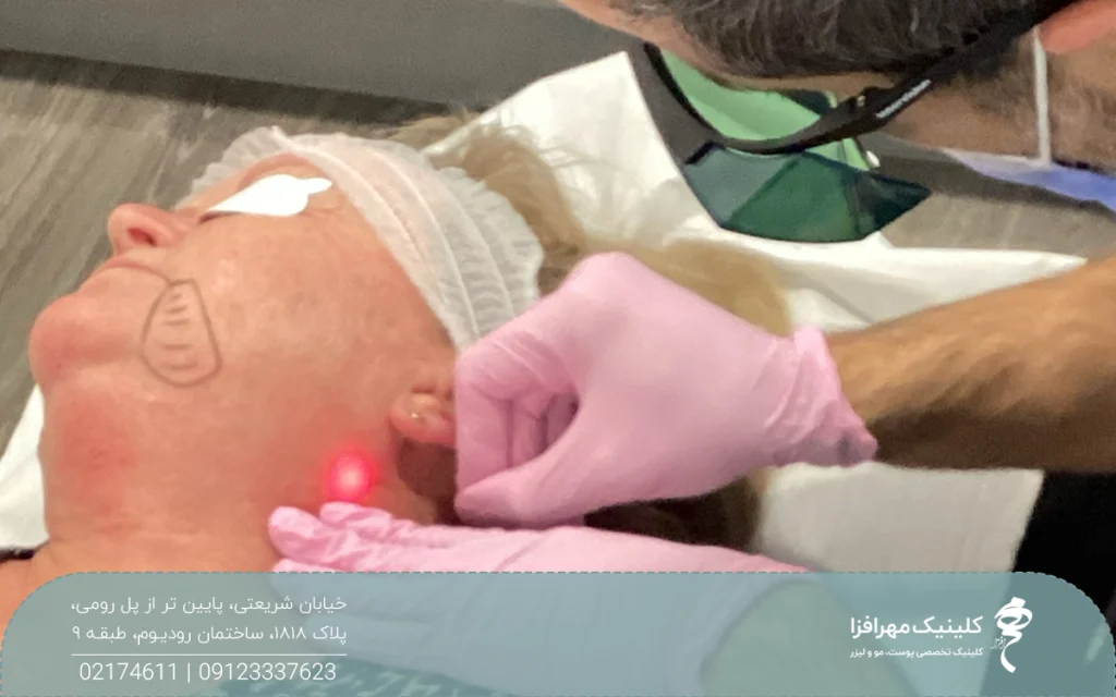 خانمی که خوابیده است و دستان پزشک با دستکش صورتی در حال انجام اندولیفت است