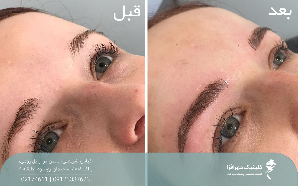 عکس قبل و بعد فردی که کاشت ابرو انجام داده است