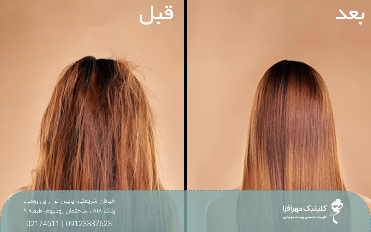 عکس قبل و بعد دختری که تزریق بوتاکس مو انجام داده است