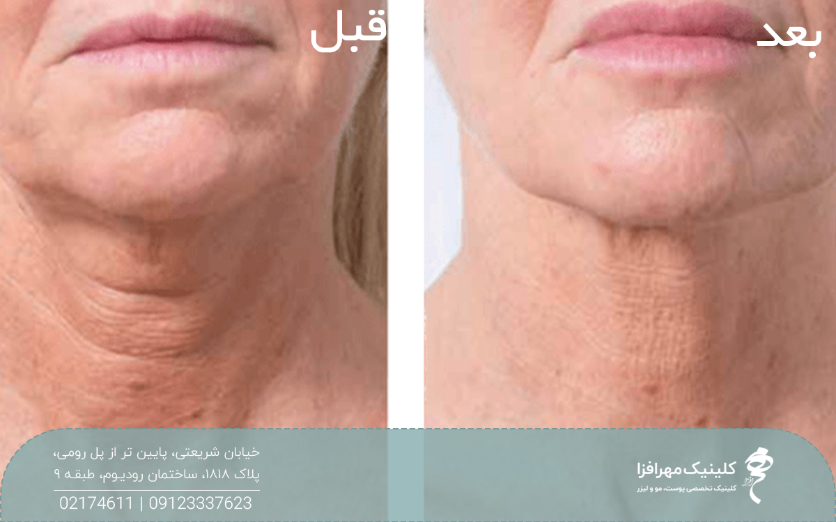عکس از قبل و بعد فردی که تزریق پروفایلو انجام داده است
