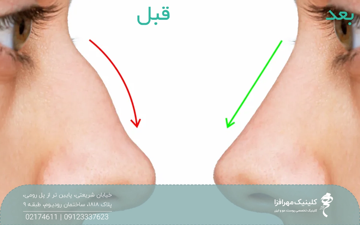 عکس قبل و بعد فردی که لیفت بینی با نخ را انجام داده است