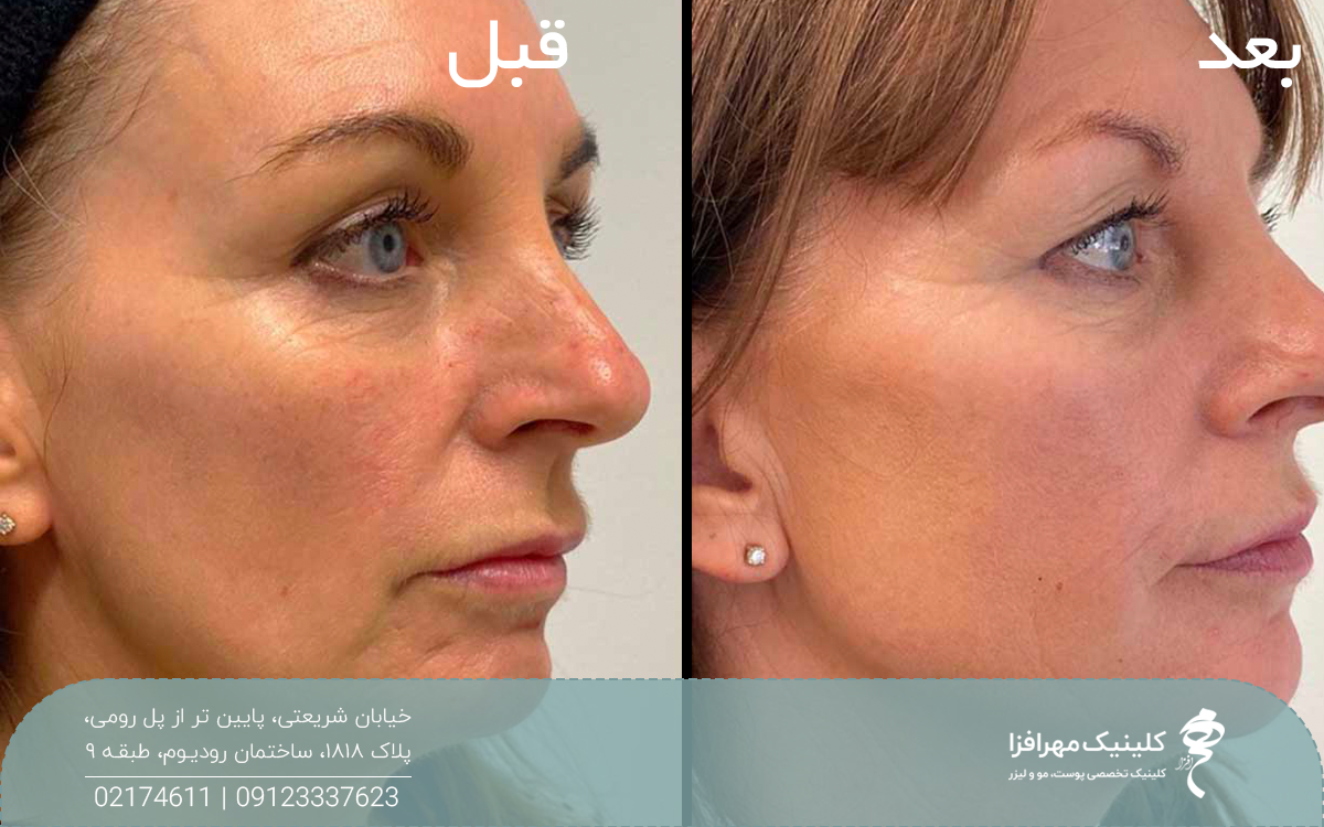 عکس قبل و بعد خانمی که لیفت شقیقه با نخ انجام داده است و چروک و افتادگی صورت او خصوصا خط اندوه و خط خنده او رفع شده است