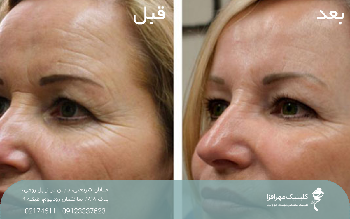 عکس قبل و بعد از نیم رخ خانم مسنی که هایفوتراپی پیشانی انجام داده است و چین و چروک پیشانی و بالای ابروهای او رفع شده است