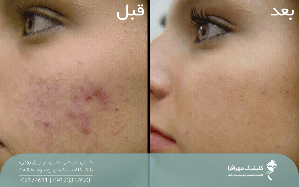 عکس قبل و بعد دختری که پیلینگ کربن انجام داده است و جای جوش و آکنه روی پوست او رفع شده است