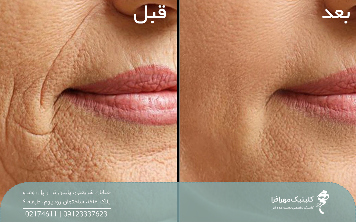 عکس قبل و بعد زنی میانسال که هایفوتراپی انجام داده است و چروک های دور لب او محو شده است