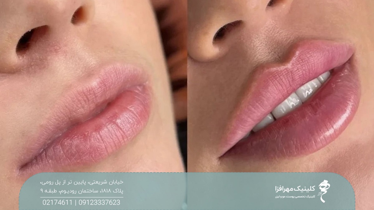 عکس قبل و بعد تزریق ژل لب روسی