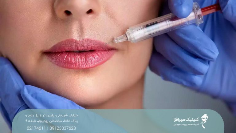 لب های دختری که پزشک یک سرنگ در آن فرو کرده و به لب بالای او ژل تزریق می کند