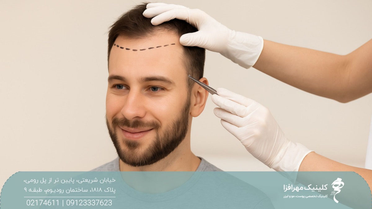 مردی که موهای جلوی سر او کم پشت شده است و خط رویش او به سمت عقب رفته و دست فردی که با یک قلم در ناحیه خط رویش سر او یک خط چین رسم کرده