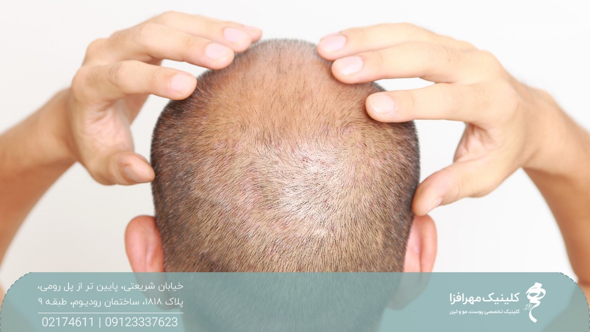 مرد با موهای کوتاه و کم پشت که دست های خود را روی فرق سرش گذاشه است