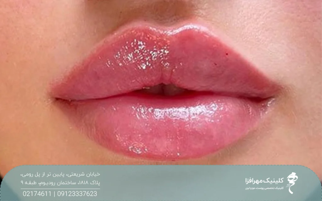 عکس از لب های فردی که ژل لب روسی تزریق کرده است