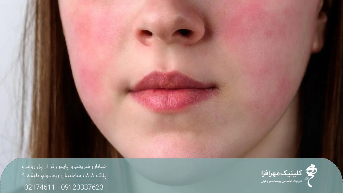 صورت دختری که بعد از تزریق پروفایلو قرمز شده است