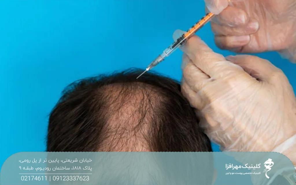 دست دکتری که دستکش شیشه ای دارد و در حال مزوتراپی مو سر فرد است