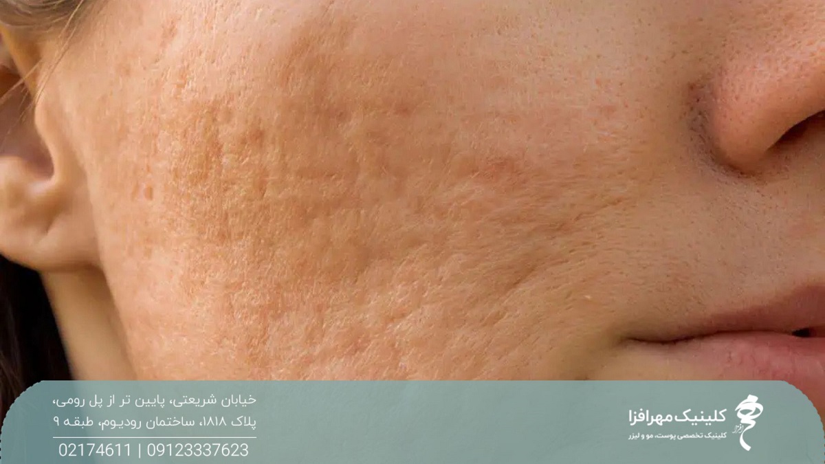 صورت دختری که پوشیده از اسکار آکنه است
