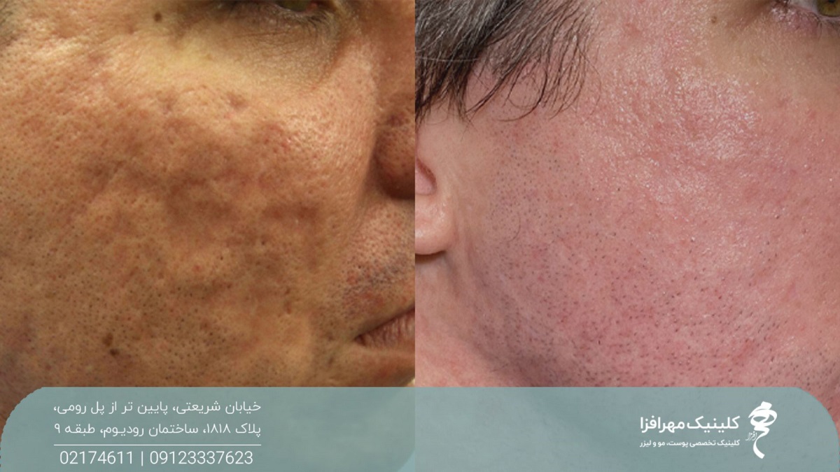 عکس قبل و بعد از سابسیژن مردی که اسکار آبله پوست او به طور کامل رفع شده است