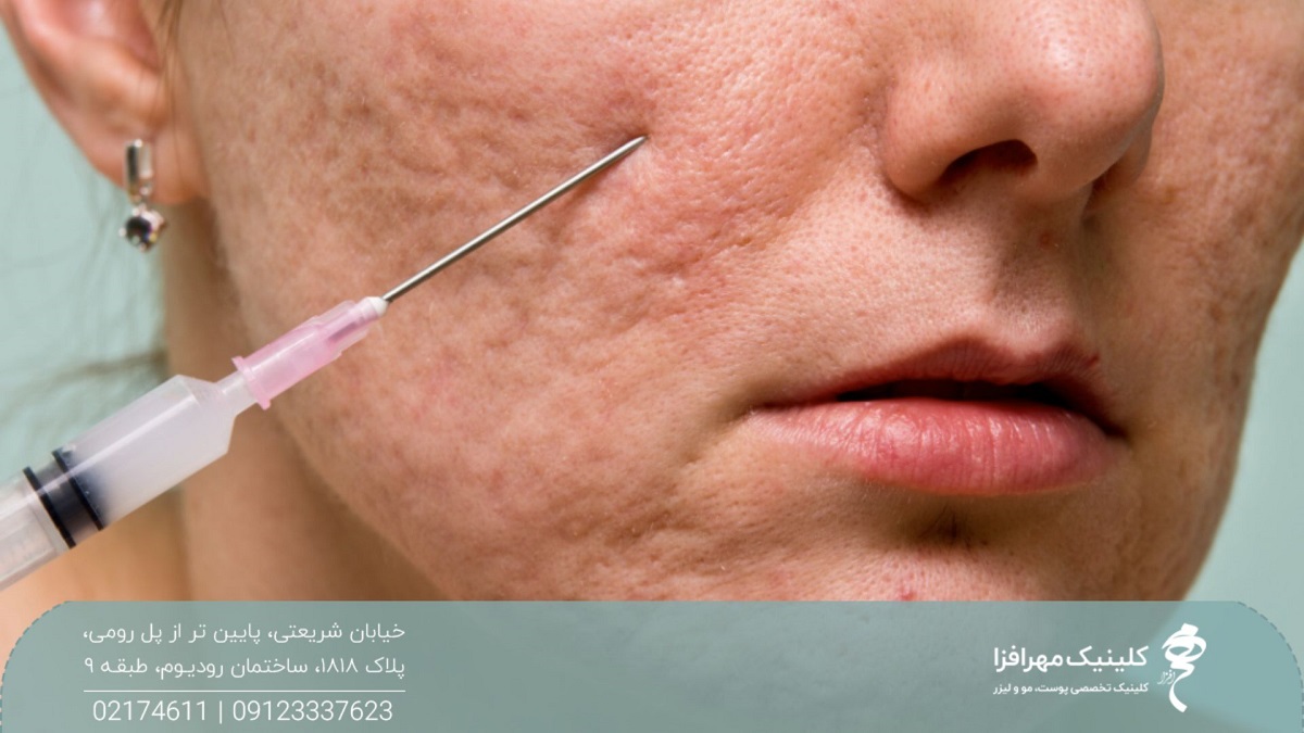 فردی که صورت او پوشیده از اسکار آکنه است و یک سوزن در صورت او فرو رفته است تا سابسیژن روی صورت او انجام شود