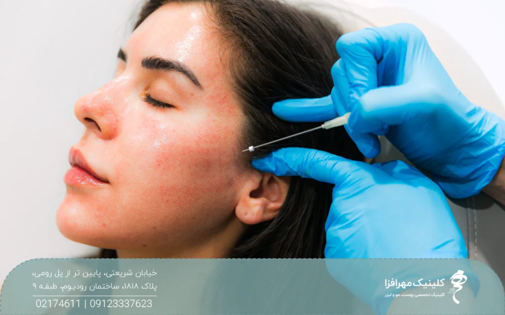 دختری که چشم هایش بسته است و دستان دکتری که در حال انجام لیفت شقیقه با نخ ایست