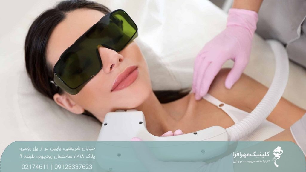 دختری که روی تخت دراز کشیده و عیک محافظ به چشم زده و اپراتور لیزر هندپیس دستگاه را روی چانه او قرار داده است