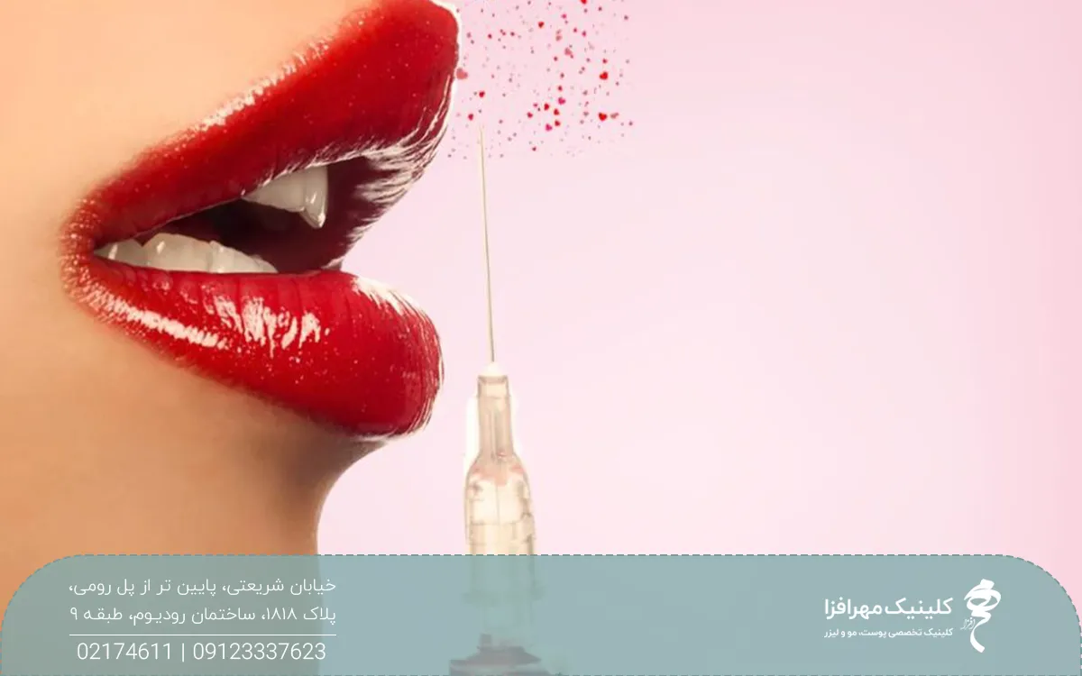 عکس از نیم رخ لب هایی که رژ لب قرمز دارد و سرنگ نزدیک لب است و قطرات قرمز رنگ در هوا پخش شده است