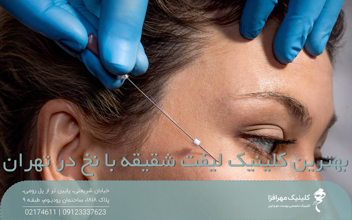 عکس از نیمه بالایی صورت دختری که پزشک نخ لیفت را روی گونه او گذاشته است و روی عکس نوشته شده بهترین کلینیک لیفت شقیقه با نخ در تهران