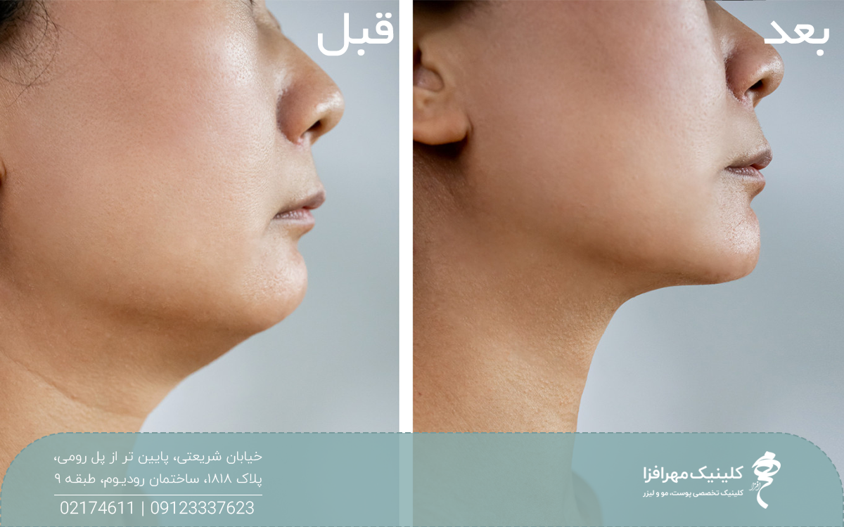 عکس قبل و بعد دختری که ساکشن غبغب انجام داده است