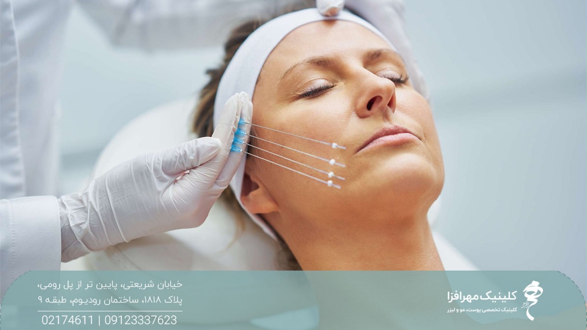 زن میانسالی که روی تخت دراز کشیده و چشم هایش بسته است و فردی نخ های لیفت را کنار صورت او گرفته است