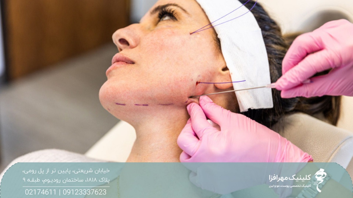 عکس پزشکی که نخ های لیفت را در صورت زن جایگذاری می کند