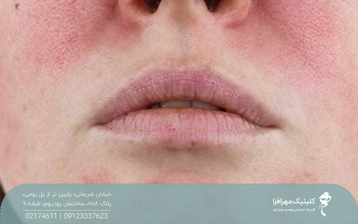 صورت فردی که دچار عوارض بعد از اندولیفت شده است و روی گونه های دچار قرمزی شده