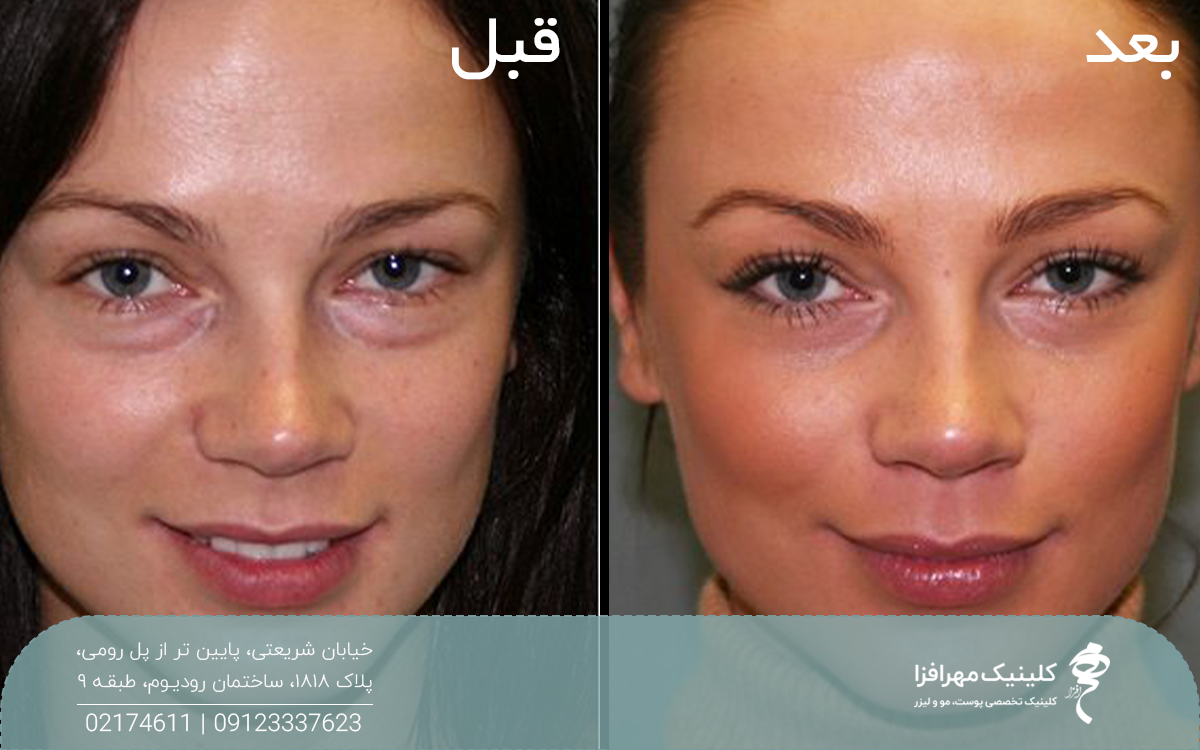 عکس قبل و بعد دختری که پی آر پی صورت انجام داده است و پوست او جوان تر شده است